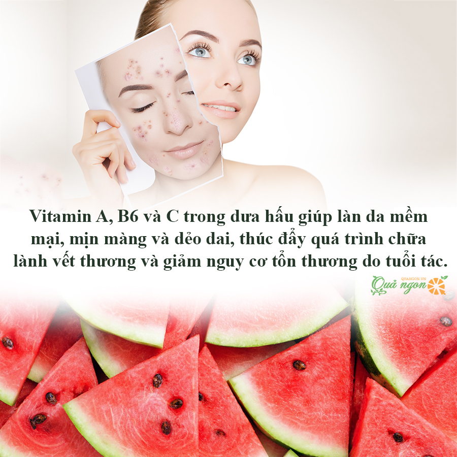 Vitamin A, B6 và C trong dưa hấu giúp làn da luôn mềm mại